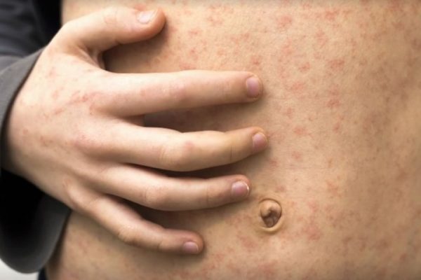 AHS warns of possible measles exposures in Taber, Whitecourt and Grimshaw